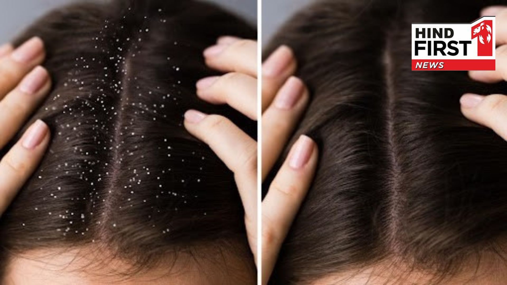 Try these four home remedies to remove dandruff from your scalp 